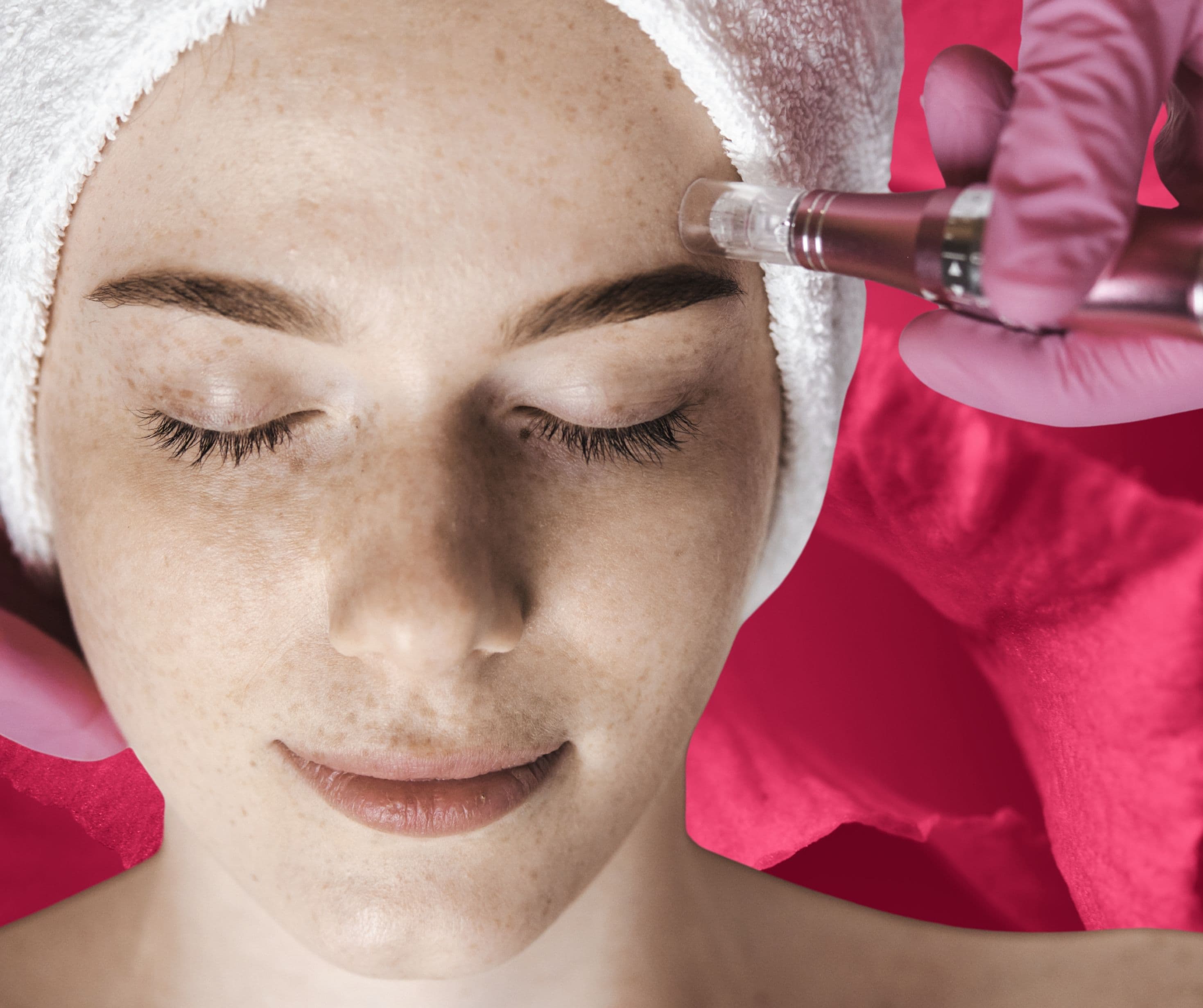 Clinic Service Microneedling