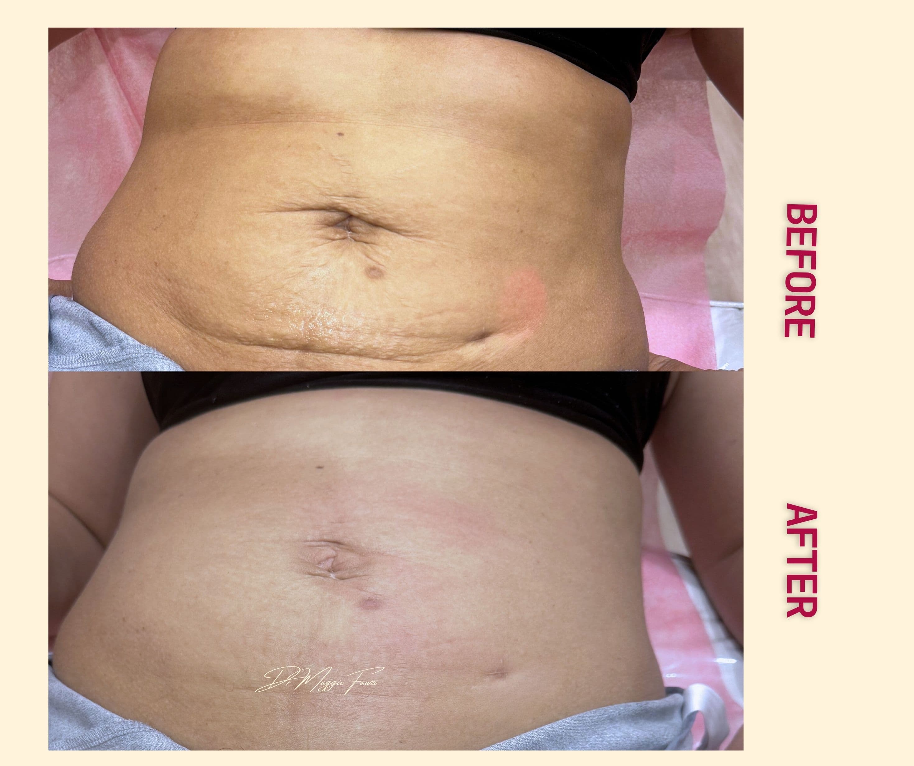 Before and After Tight sculpting