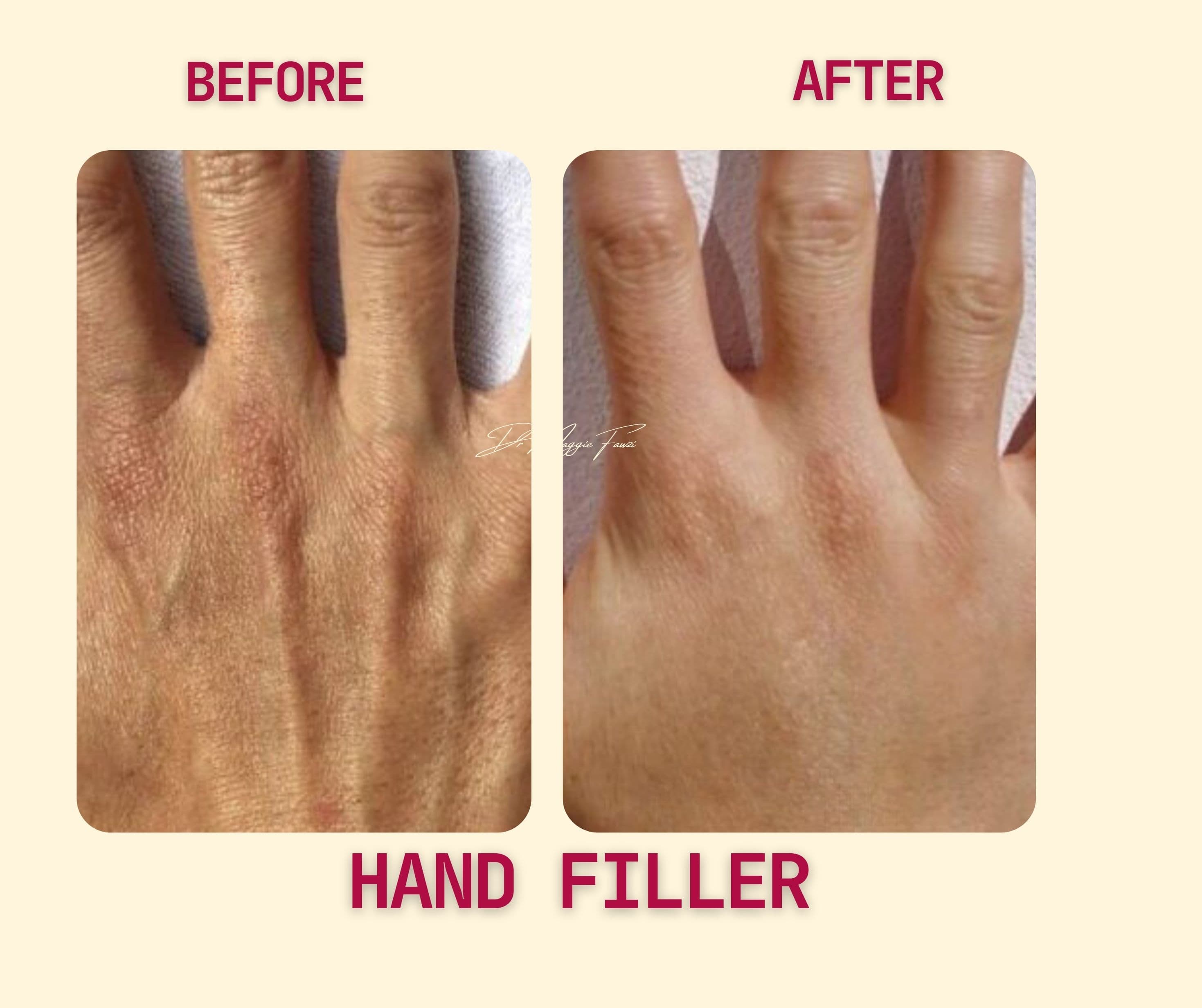 Before and After hand filler