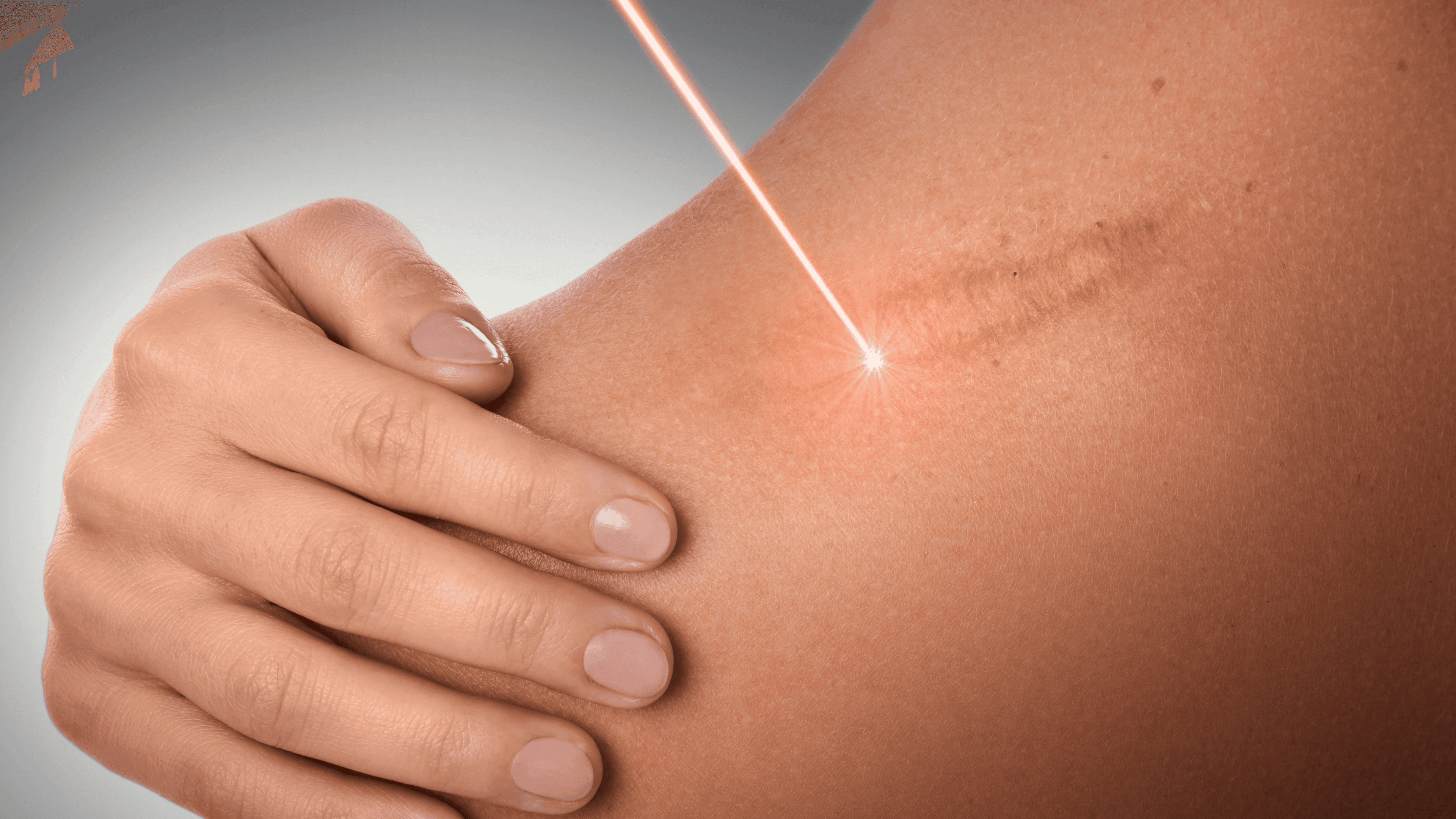 Laser Cold And Warm Peel