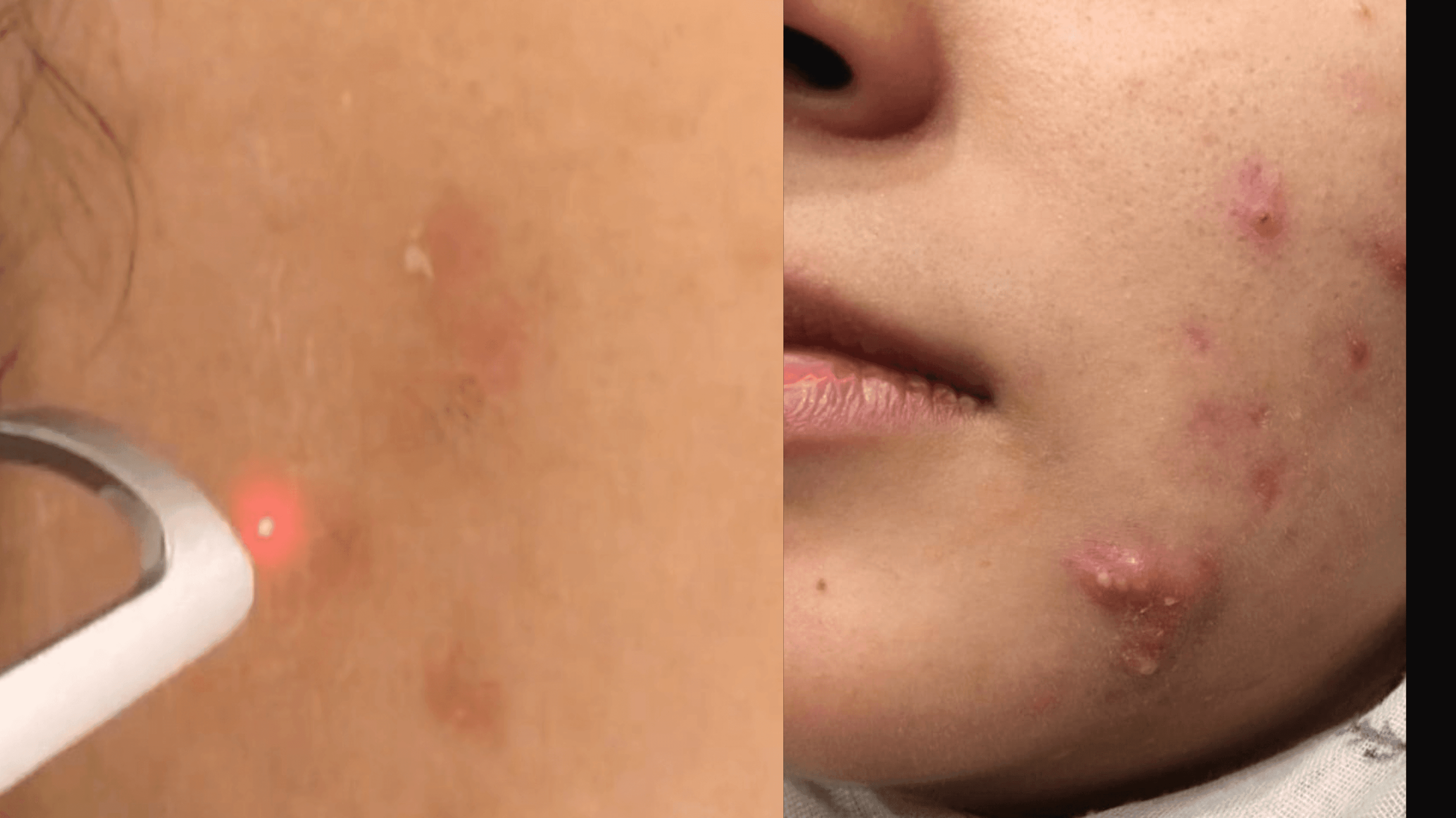 Acne TwinLight Laser