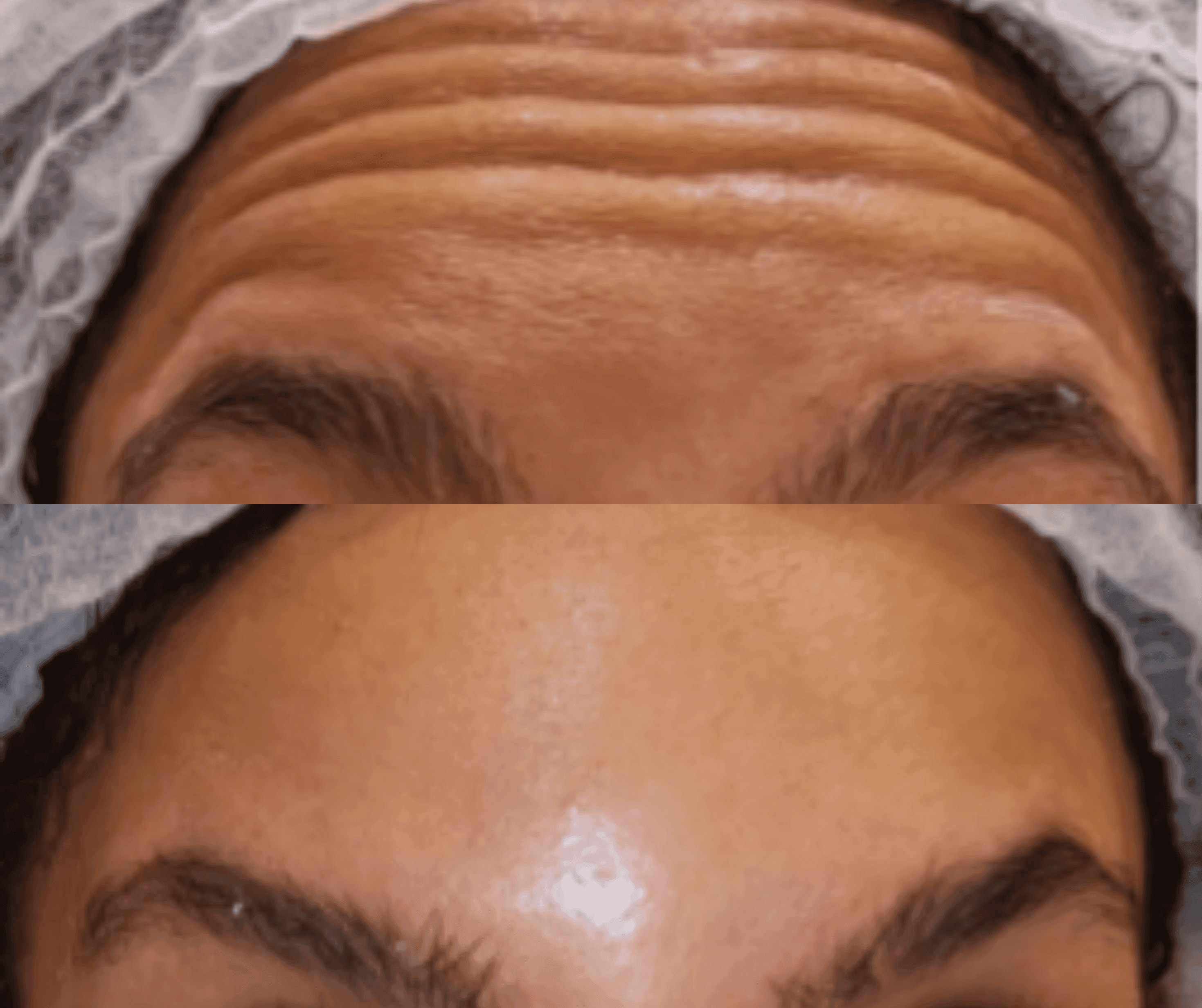 Before and After Botox
