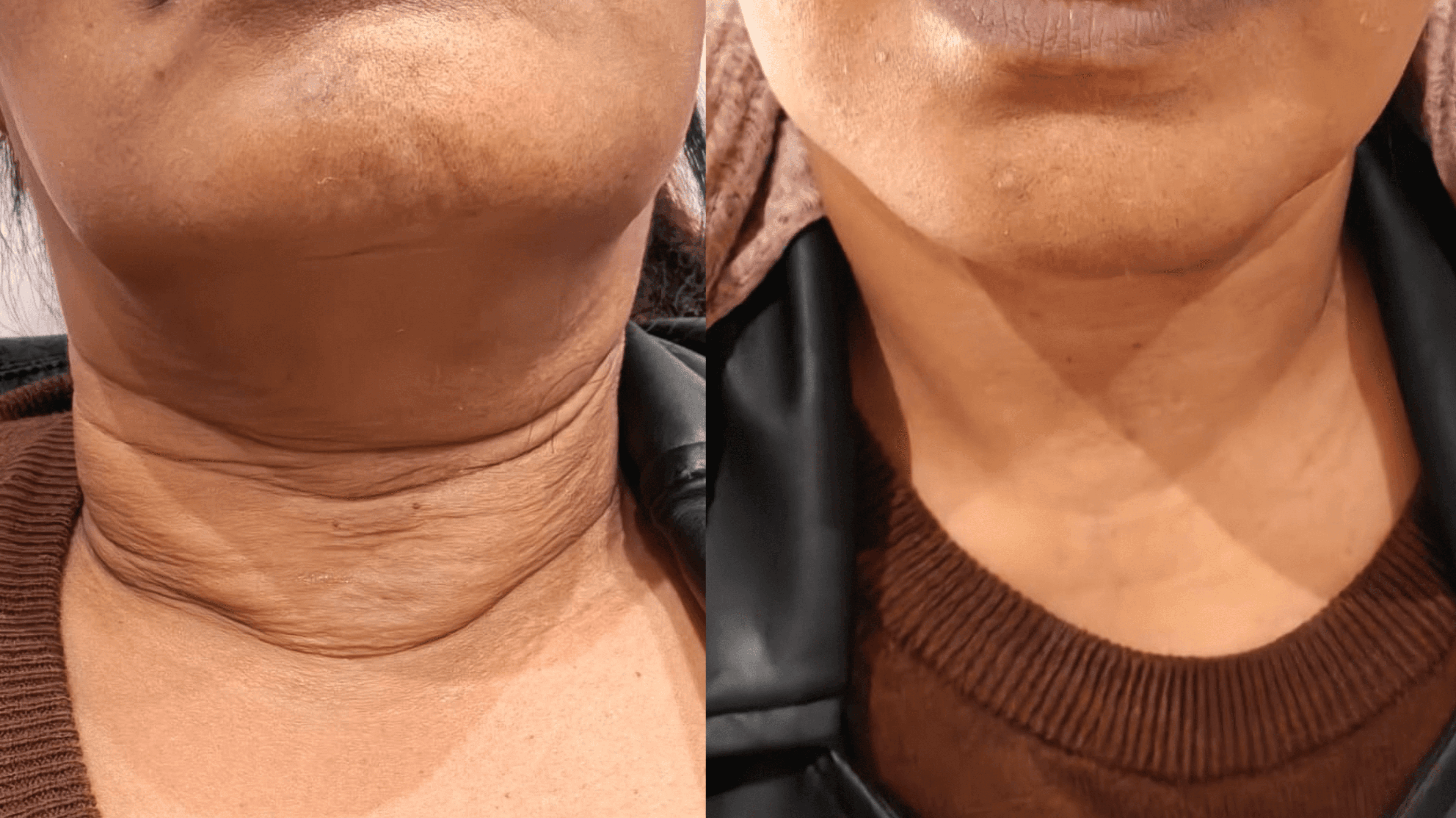 Before and After 4d Face Lift