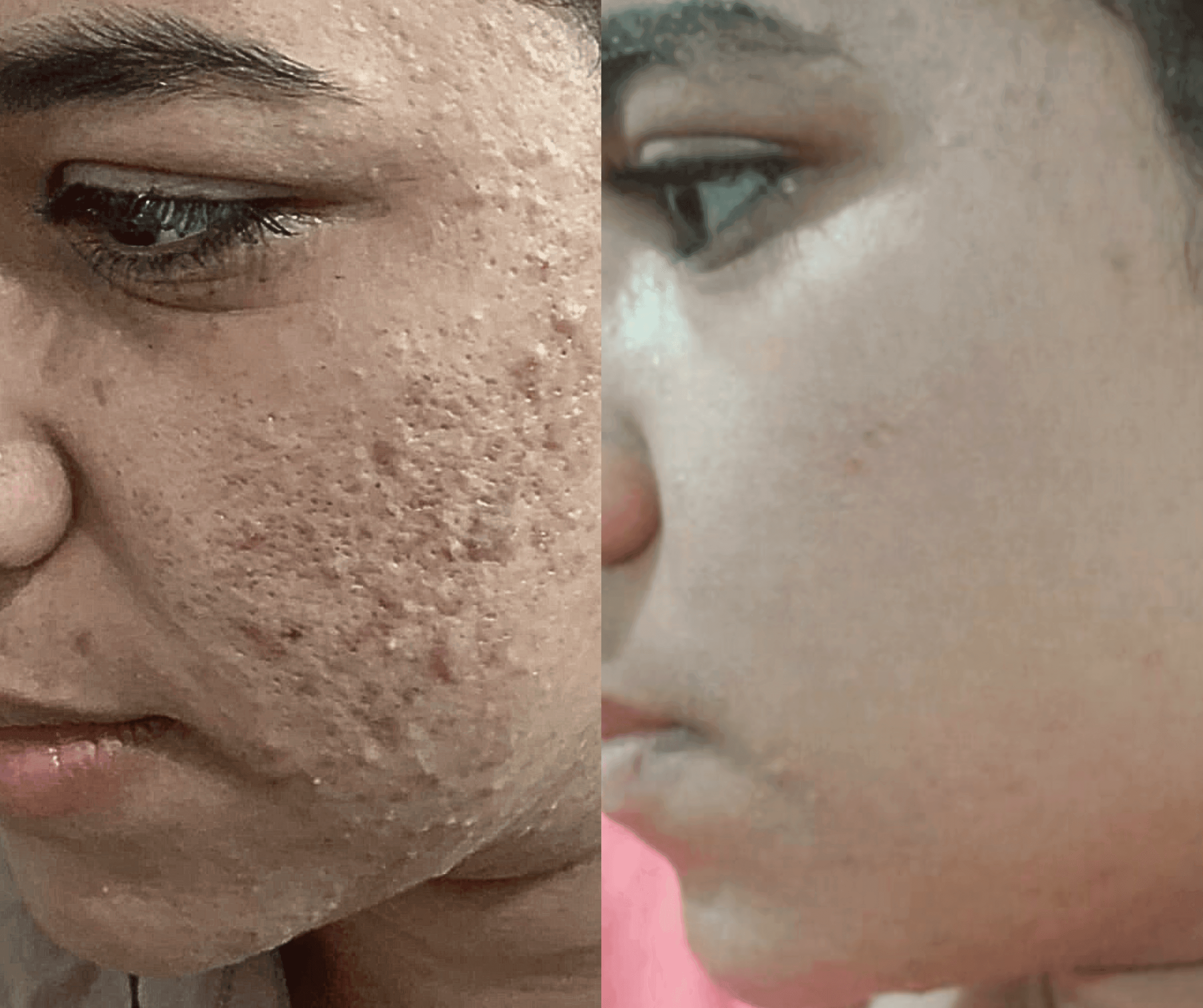 Before and After Laser Resurfacing