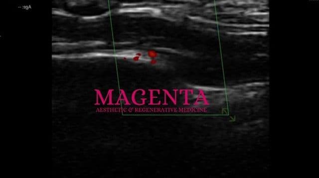 Ultrasoud mapping of skin