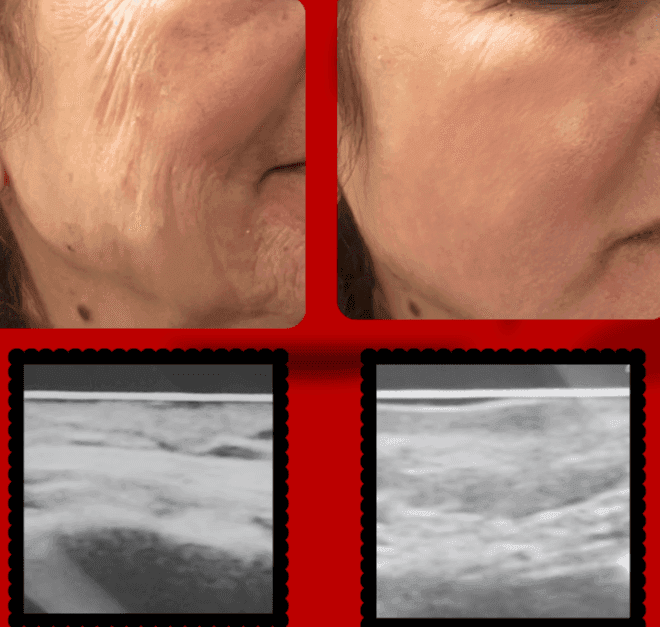 The Future of Aesthetics: A Definitive Guide to Biostimulators (Sculptra, Radiesse, SFERA & Olidia)