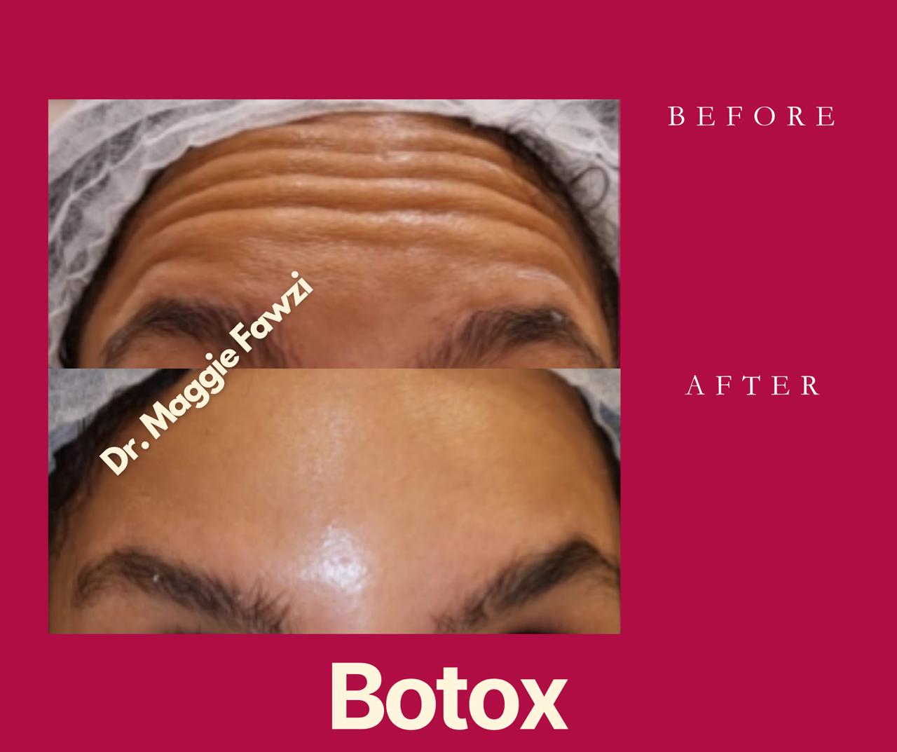 Botox in New Cairo at Magenta Clinique