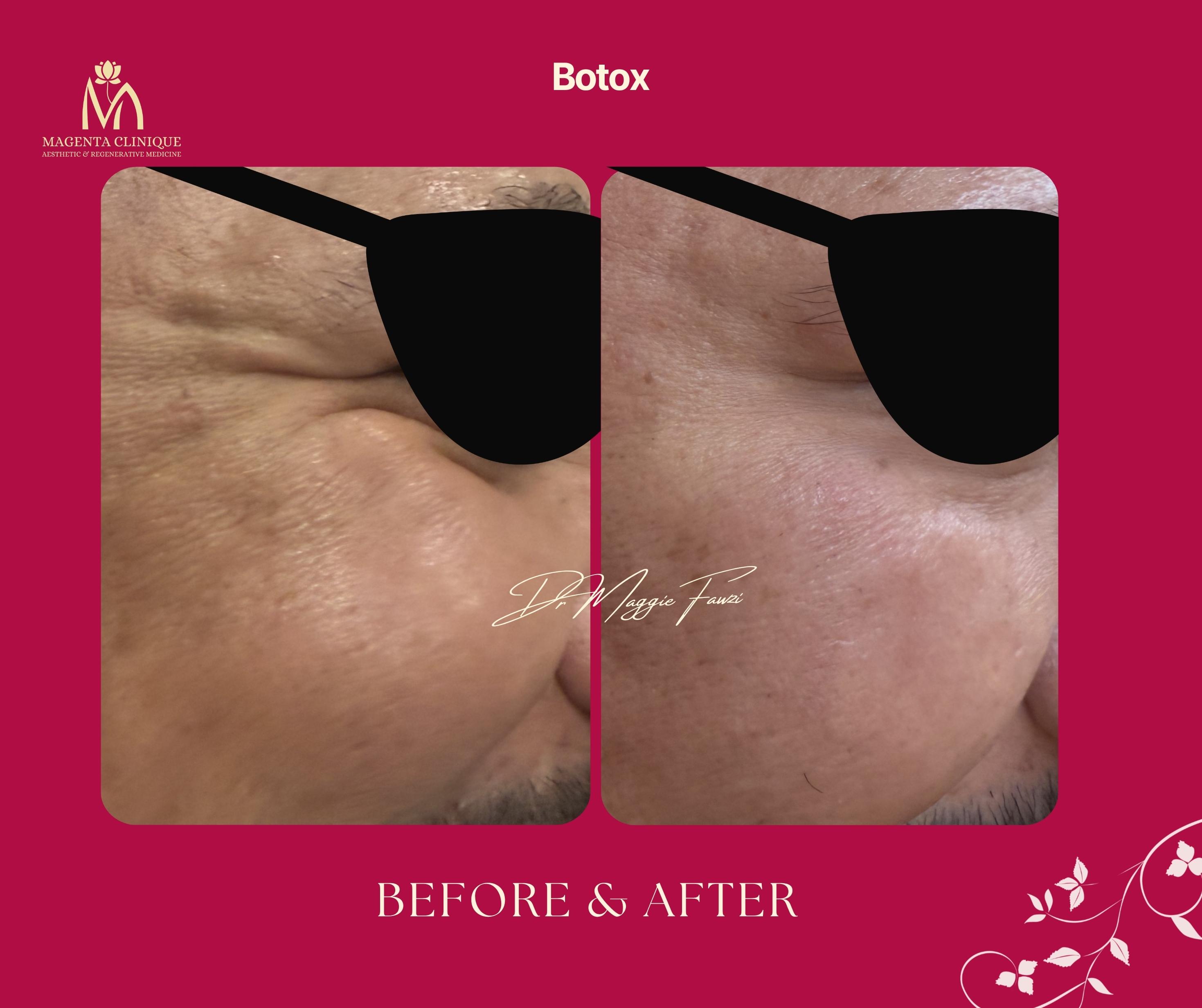 Botox Crow's Feet Before and After at Magenta Clinique Maadi